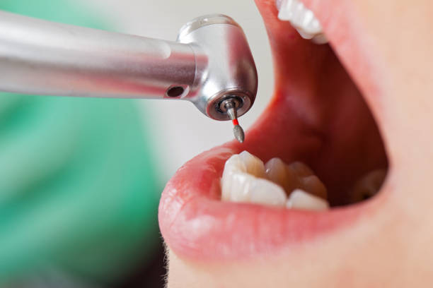 Best Emergency Root Canal Treatment in San Elizario, TX